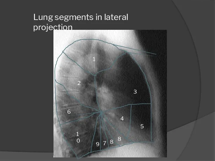 1 2 3 6 10 4 5 Lung segments in lateral projection 9 7 8 8