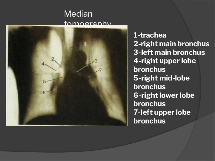 Median tomography 1-trachea 2-right main bronchus 3-left main bronchus 4-right upper lobe bronchus
