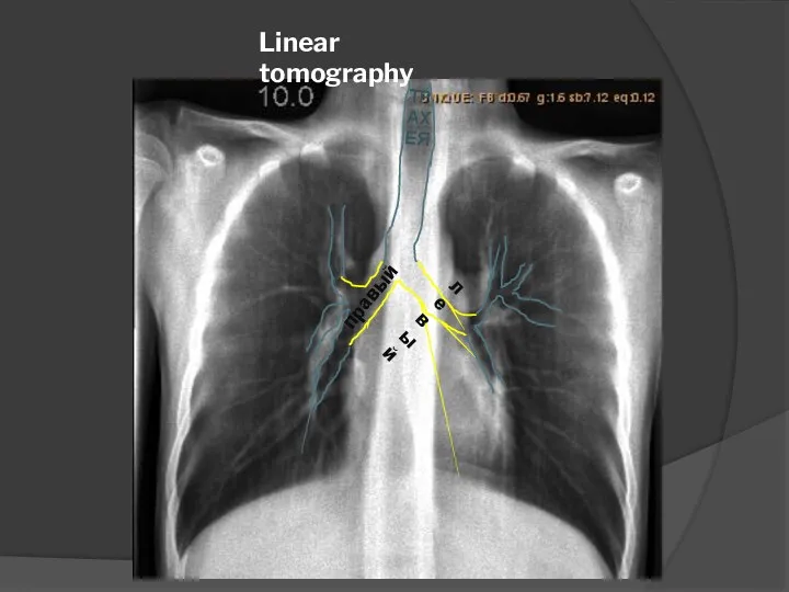 Linear tomography ТРАХЕЯ правый левый
