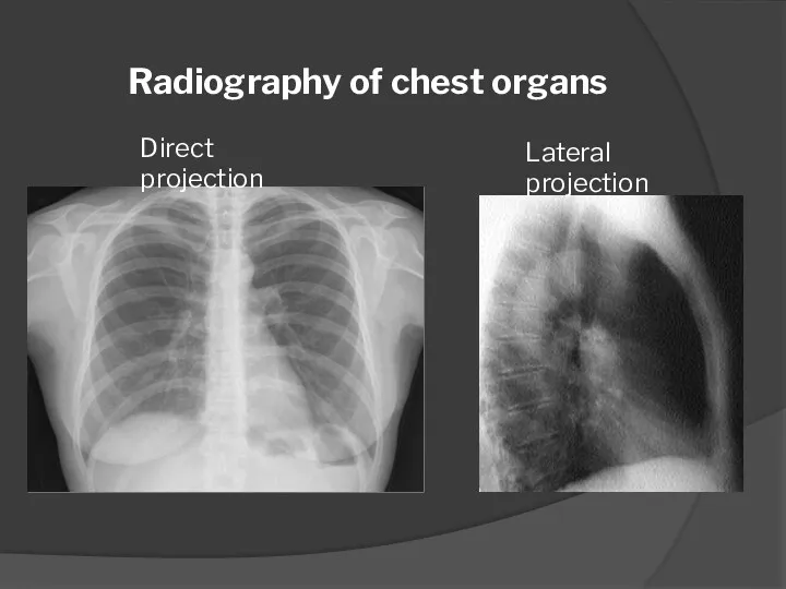 Direct projection Lateral projection Radiography of chest organs