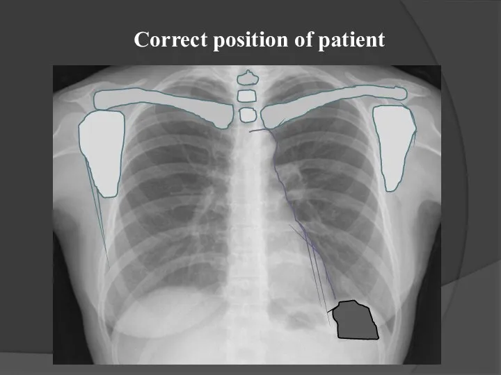 Correct position of patient