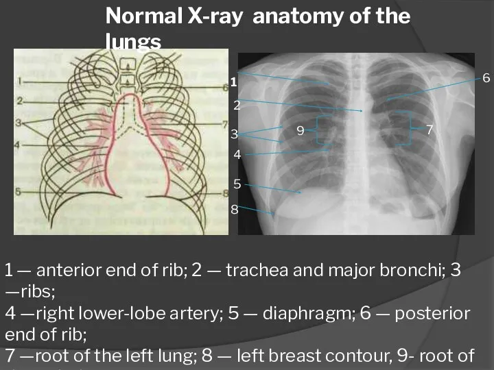 1 — anterior end of rib; 2 — trachea and major bronchi; 3