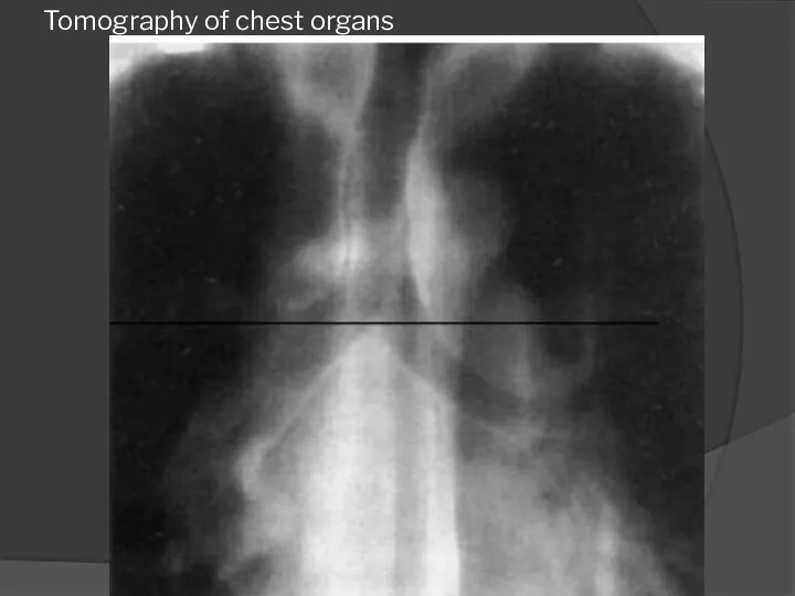 Tomography of chest organs