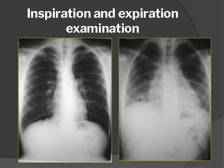 Inspiration and expiration examination 6 4