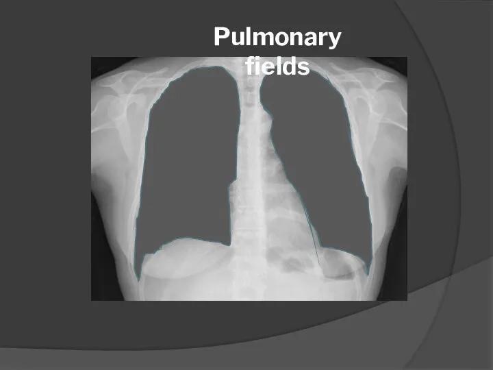 Pulmonary fields