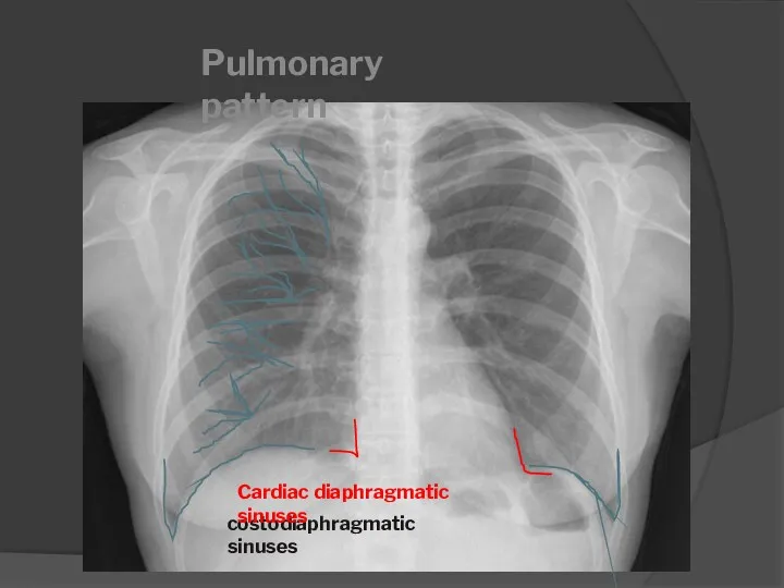 costodiaphragmatic sinuses Pulmonary pattern Cardiac diaphragmatic sinuses