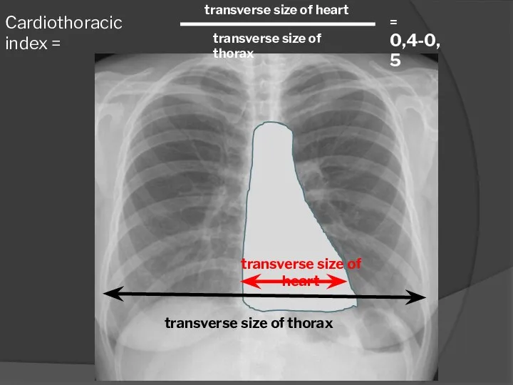 Cardiothoracic index = transverse size of heart transverse size of thorax transverse size