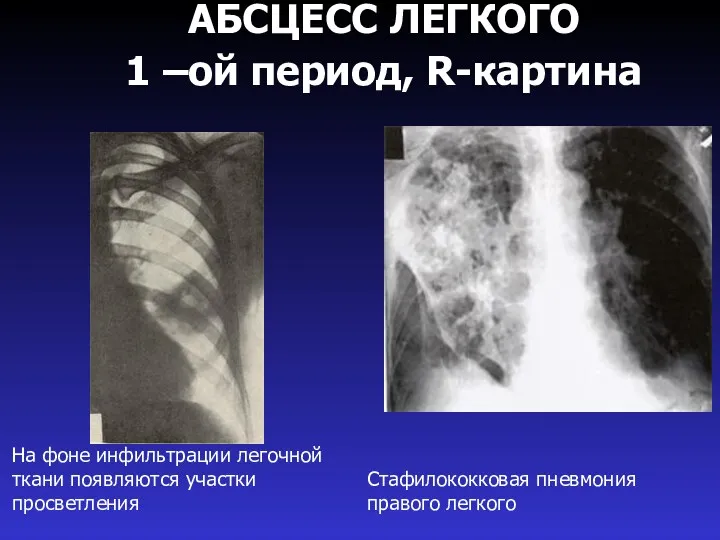 АБСЦЕСС ЛЕГКОГО 1 –ой период, R-картина Стафилококковая пневмония правого легкого На фоне инфильтрации