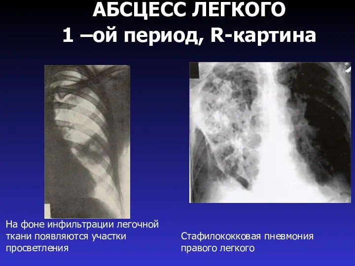 АБСЦЕСС ЛЕГКОГО 1 –ой период, R-картина Стафилококковая пневмония правого легкого