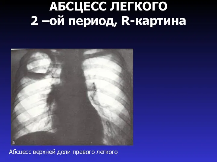 АБСЦЕСС ЛЕГКОГО 2 –ой период, R-картина Абсцесс верхней доли правого легкого