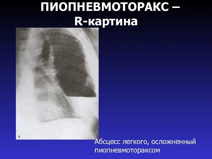 ПИОПНЕВМОТОРАКС – R-картина Абсцесс легкого, осложненный пиопневмотораксом