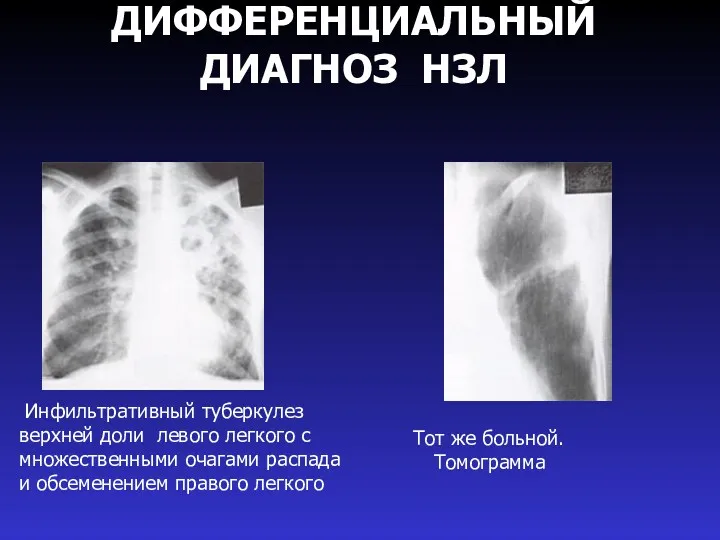 ДИФФЕРЕНЦИАЛЬНЫЙ ДИАГНОЗ НЗЛ Тот же больной. Томограмма Инфильтративный туберкулез верхней доли левого легкого