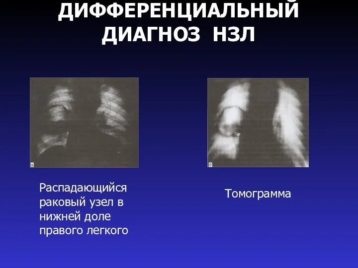 ДИФФЕРЕНЦИАЛЬНЫЙ ДИАГНОЗ НЗЛ Томограмма