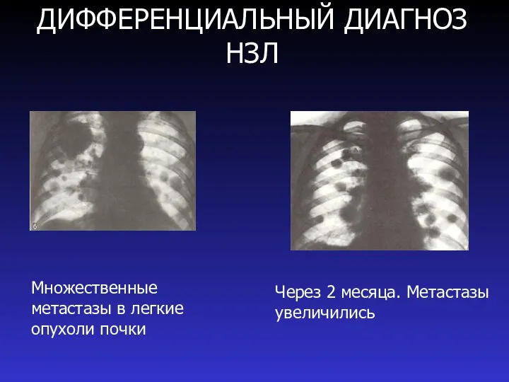 ДИФФЕРЕНЦИАЛЬНЫЙ ДИАГНОЗ НЗЛ Через 2 месяца. Метастазы увеличились Множественные метастазы в легкие опухоли почки