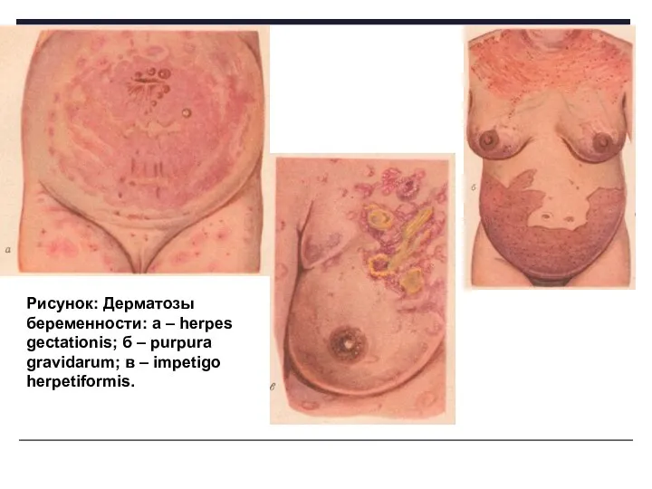 Рисунок: Дерматозы беременности: a – herpes gectationis; б – purpura gravidarum; в – impetigo herpetiformis.