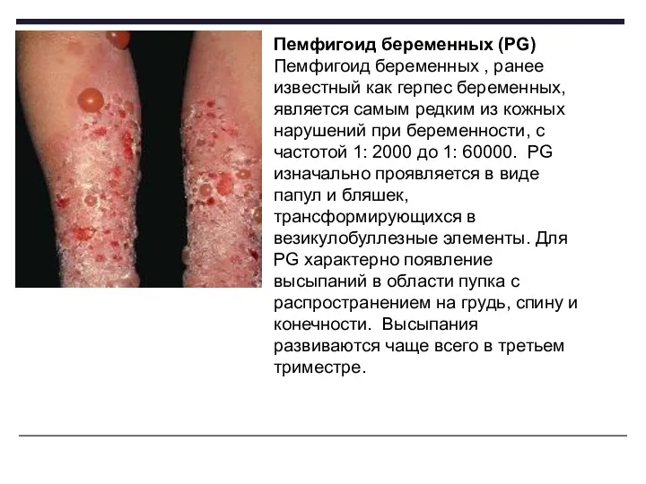 Пемфигоид беременных (PG) Пемфигоид беременных , ранее известный как герпес