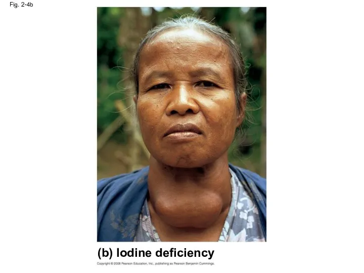 Fig. 2-4b (b) Iodine deficiency