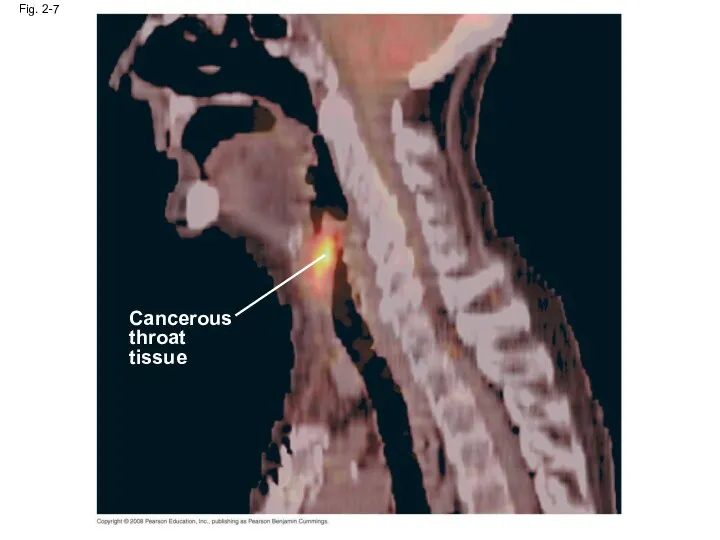 Fig. 2-7 Cancerous throat tissue