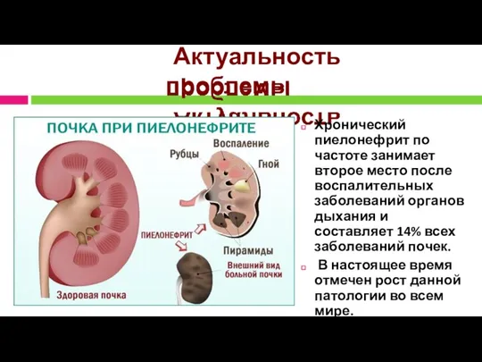 Актуальность проблемы Хронический пиелонефрит по частоте занимает второе место после