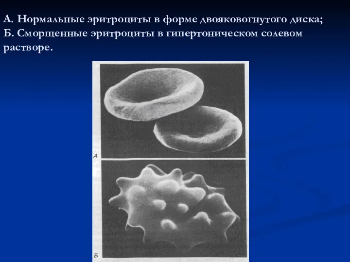 А. Нормальные эритроциты в форме двояковогнутого диска; Б. Сморщенные эритроциты в гипертоническом солевом растворе.