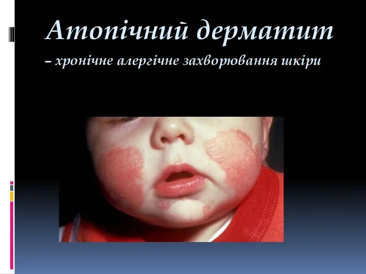 Атопічний дерматит – хронічне алергічне захворювання шкіри