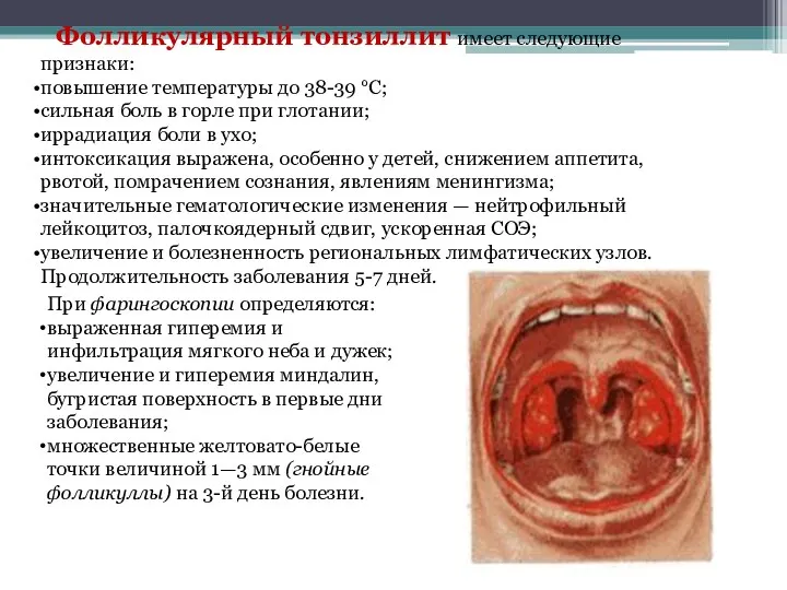 Фолликулярный тонзиллит имеет следующие признаки: повышение температуры до 38-39 °С;