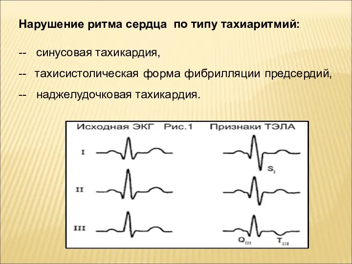 Нарушение ритма сердца по типу тахиаритмий: -- синусовая тахикардия, --