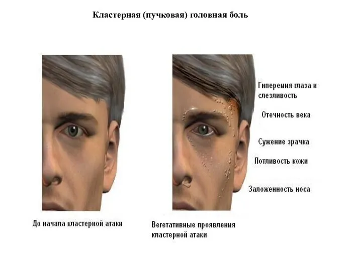 Кластерная (пучковая) головная боль