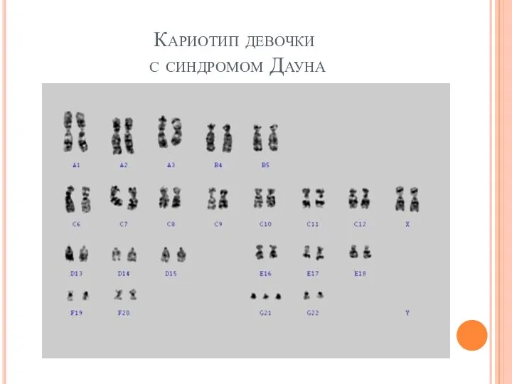 Кариотип девочки с синдромом Дауна