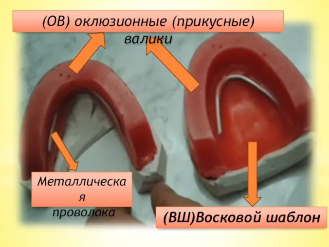 (ОВ) оклюзионные (прикусные) валики (ВШ)Восковой шаблон Металлическая проволока