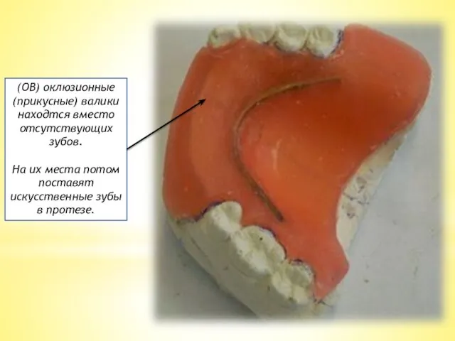 (ОВ) оклюзионные (прикусные) валики находтся вместо отсутствующих зубов. На их