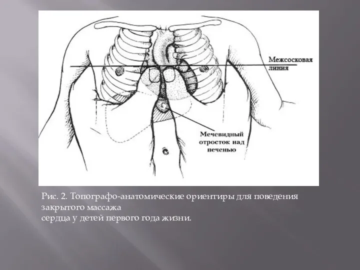 Рис. 2. Топографо-анатомические ориентиры для поведения закрытого массажа сердца у детей первого года жизни.