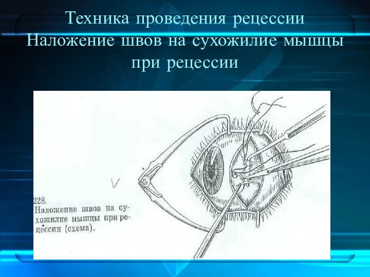 Техника проведения рецессии Наложение швов на сухожилие мышцы при рецессии