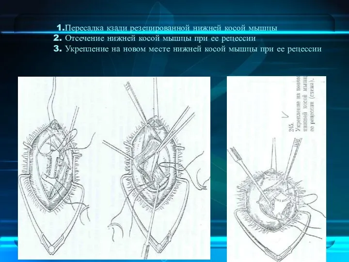 1.Пересадка кзади резецированной нижней косой мышцы 2. Отсечение нижней косой