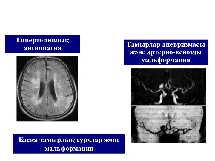 Гипертониялық ангиопатия Тамырлар аневризмасы және артерио-венозды мальформация Басқа тамырлық аурулар және мальформация АГ