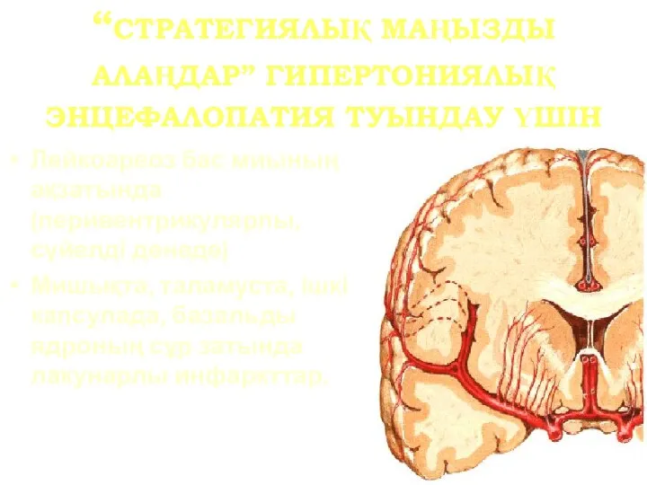 “СТРАТЕГИЯЛЫҚ МАҢЫЗДЫ АЛАҢДАР” ГИПЕРТОНИЯЛЫҚ ЭНЦЕФАЛОПАТИЯ ТУЫНДАУ ҮШІН Лейкоареоз бас миының ақзатында(перивентрикулярлы, сүйелді денеде)