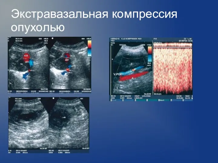 Экстравазальная компрессия опухолью