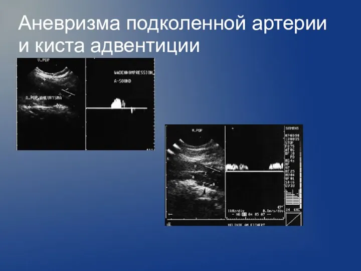 Аневризма подколенной артерии и киста адвентиции