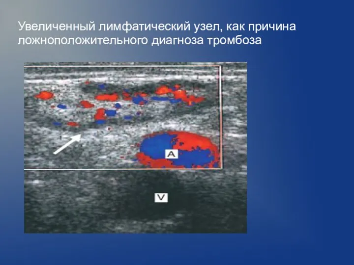 Увеличенный лимфатический узел, как причина ложноположительного диагноза тромбоза