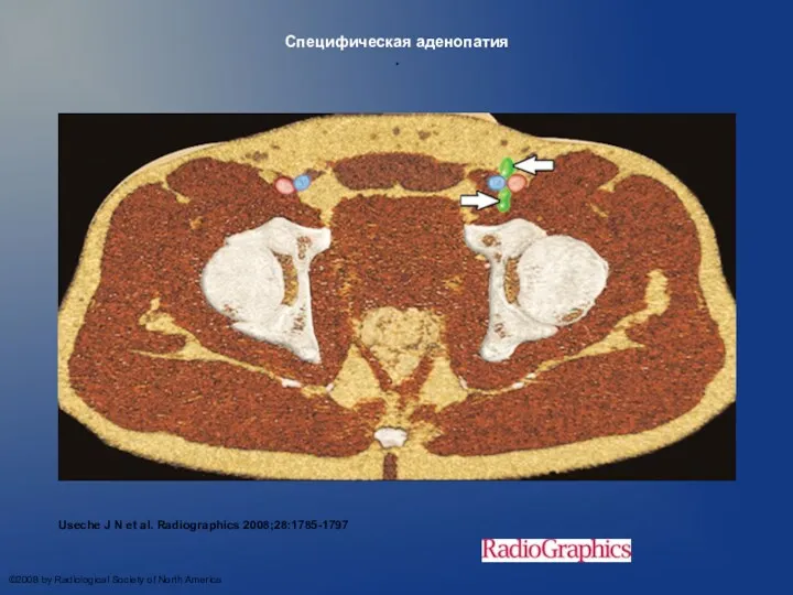 Специфическая аденопатия . Useche J N et al. Radiographics 2008;28:1785-1797