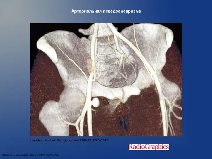 Артериальная псведоаневризма Useche J N et al. Radiographics 2008;28:1785-1797 ©2008 by Radiological Society of North America