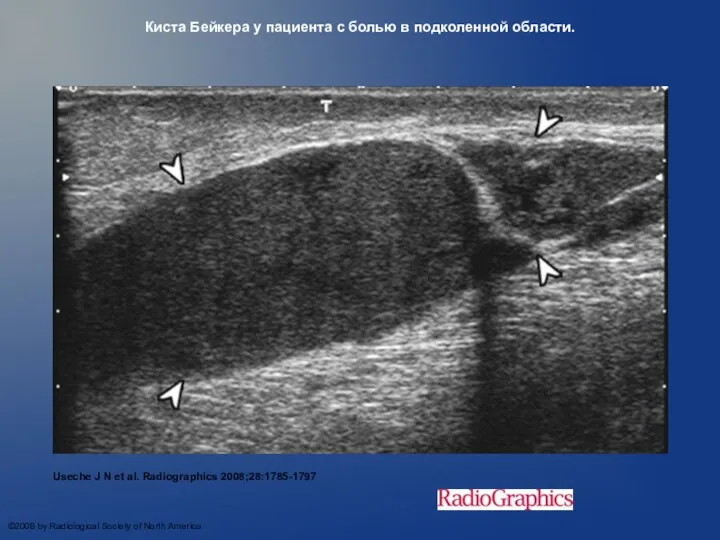 Киста Бейкера у пациента с болью в подколенной области. Useche