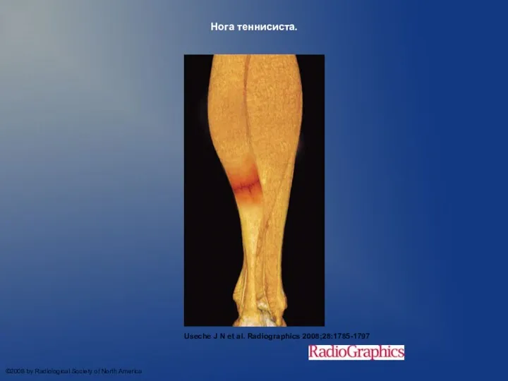 Нога теннисиста. Useche J N et al. Radiographics 2008;28:1785-1797 ©2008 by Radiological Society of North America