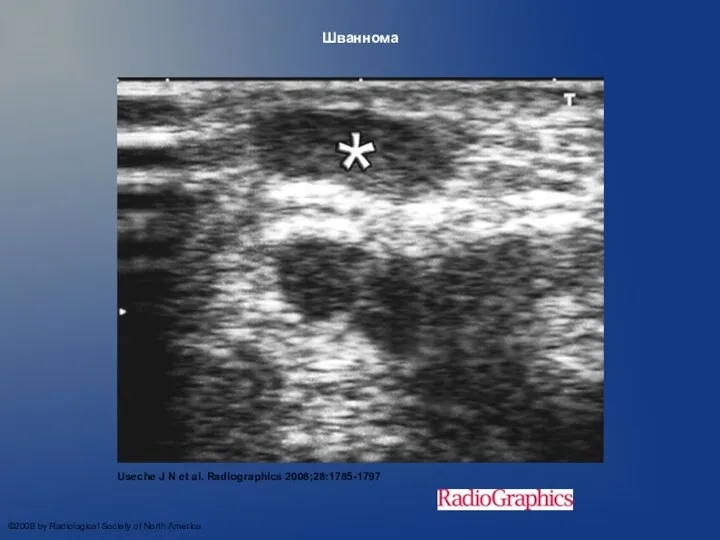 Шваннома Useche J N et al. Radiographics 2008;28:1785-1797 ©2008 by Radiological Society of North America