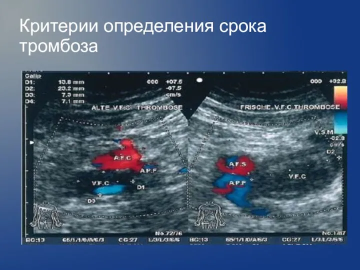 Критерии определения срока тромбоза