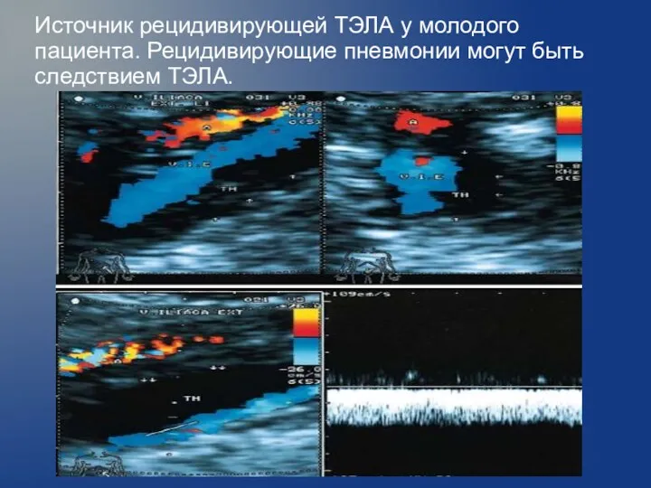 Источник рецидивирующей ТЭЛА у молодого пациента. Рецидивирующие пневмонии могут быть следствием ТЭЛА.