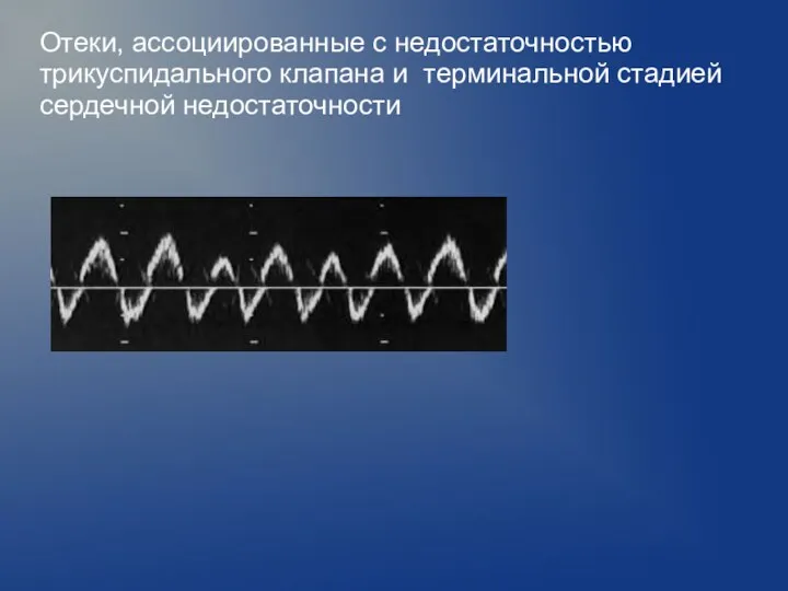 Отеки, ассоциированные с недостаточностью трикуспидального клапана и терминальной стадией сердечной недостаточности