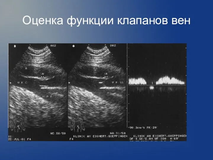 Оценка функции клапанов вен