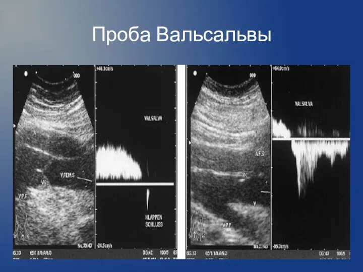 Проба Вальсальвы