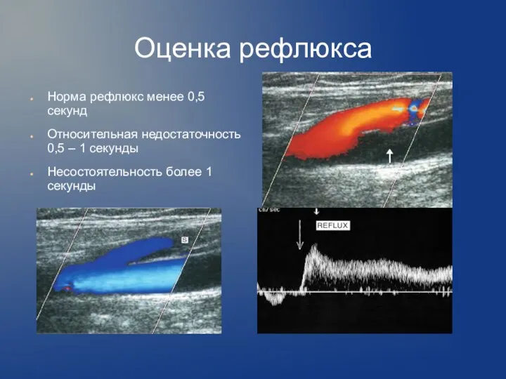 Оценка рефлюкса Норма рефлюкс менее 0,5 секунд Относительная недостаточность 0,5